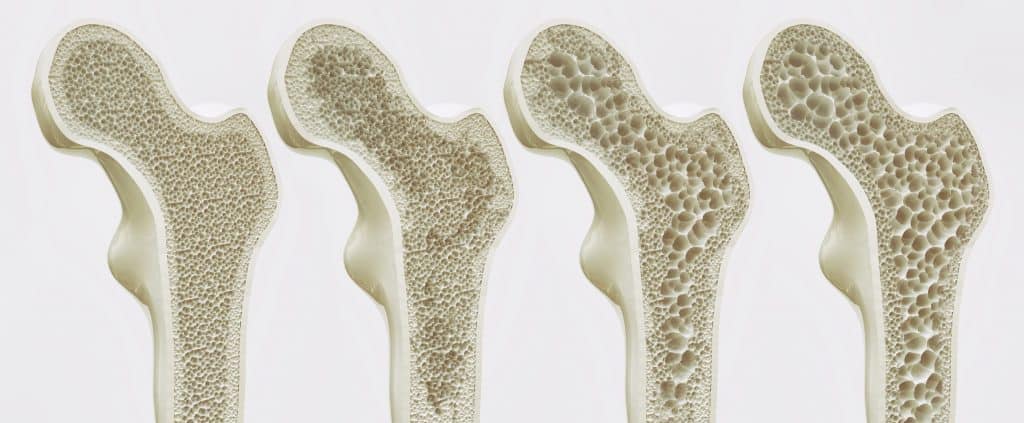 Osteopenia e Osteoporose